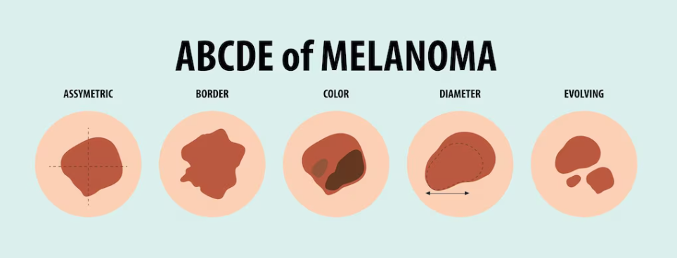 A regra do ABCDE identifica sinais suspeitos ao observar a Assimetria da forma, a irregularidade das Bordas, a variação de Cores, o Diâmetro maior que 6mm e a Evolução ou mudanças ao longo do tempo, servindo como guia essencial para o diagnóstico precoce do melanoma, o mais perigoso câncer de pele. 