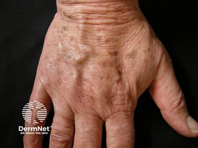 O lentigo solar, popularmente conhecido como "mancha senil" ou "mancha de sol", é uma pequena lesão benigna da pele causada pelo dano acumulado da radiação ultravioleta (UVA e UVB) ao longo dos anos. Ele surge devido a uma hiperplasia (aumento do número) de melanócitos na camada basal da epiderme. Apresenta-se como pequenas manchas isoladas e de bordas bem definidas, enquanto o melasma manifesta-se em manchas maiores, irregulares e geralmente simétricas, influenciadas por fatores hormonais.