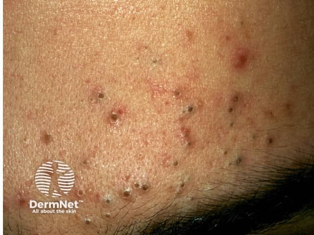A acne comedoniana é a forma mais leve e inicial da acne, caracterizada principalmente pelos famosos cravos brancos e pretos sem presença de pus ou dor. Ela surge quando os poros ficam entupidos por um excesso de gordura e células mortas, mas ainda não houve uma infecção bacteriana significativa. Os pontos pretos ganham essa cor devido ao contato da gordura com o ar, enquanto os brancos permanecem fechados sob uma fina camada de pele. Para tratar essa condição, o foco principal é a limpeza adequada e o uso de substâncias que ajudem a desobstruir os poros e controlar a oleosidade. Manter uma rotina de cuidados simples geralmente evita que esses cravos evoluam para espinhas inflamadas e doloridas.