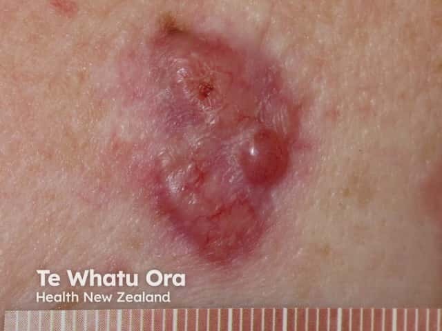 O carcinoma basocelular (CBC) nodular é o subtipo mais comum desse câncer de pele, surgindo geralmente como uma pápula elevada, brilhante e de aspecto "perolado". Ele apresenta vasos sanguíneos dilatados na superfície (telangiectasias) e, com o tempo, pode desenvolver uma ulceração. 