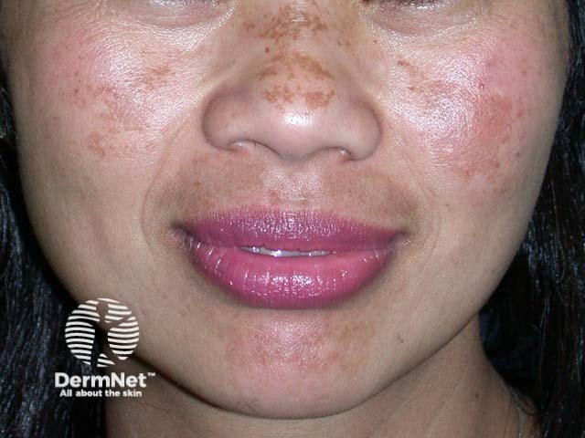 O melasma facial impacta profundamente a autoestima e a identidade, pois as manchas são difíceis de camuflar e ficam em constante evidência social. Esse comprometimento estético pode gerar quadros de ansiedade, retraimento e insegurança, afetando as relações pessoais e profissionais do paciente. A busca incessante por tratamentos reflete o peso emocional de carregar marcas que alteram a percepção da própria face.