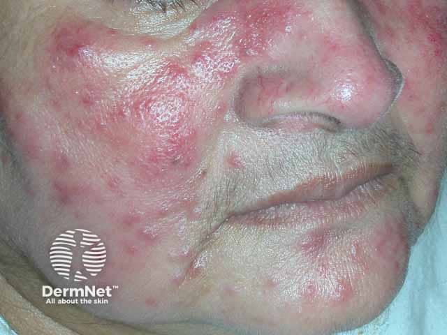 No segundo estágio da rosácea (grau 2), além da vermelhidão persistente, surgem pequenas lesões inflamadas que se assemelham a espinhas, conhecidas como pápulas e pústulas. Diferente da acne, aqui não costumam aparecer cravos, e a pele tende a ficar extremamente sensível e reativa. É um quadro que exige cuidados específicos para controlar a inflamação e devolver o conforto ao rosto.