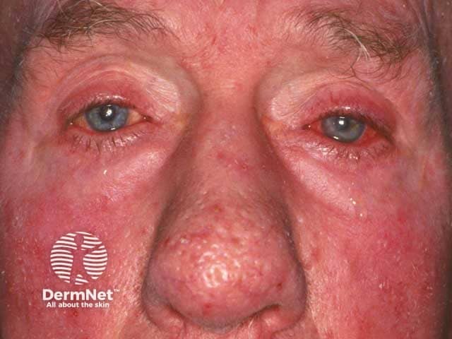 Muitas pessoas não sabem, mas a rosácea pode afetar os olhos, causando irritação, vermelhidão e uma sensação persistente de areia ou corpo estranho. Se não for identificada, essa condição pode levar a inflamações nas pálpebras e até comprometer a visão em casos mais severos. O acompanhamento conjunto é essencial para aliviar o desconforto e proteger a saúde ocular.