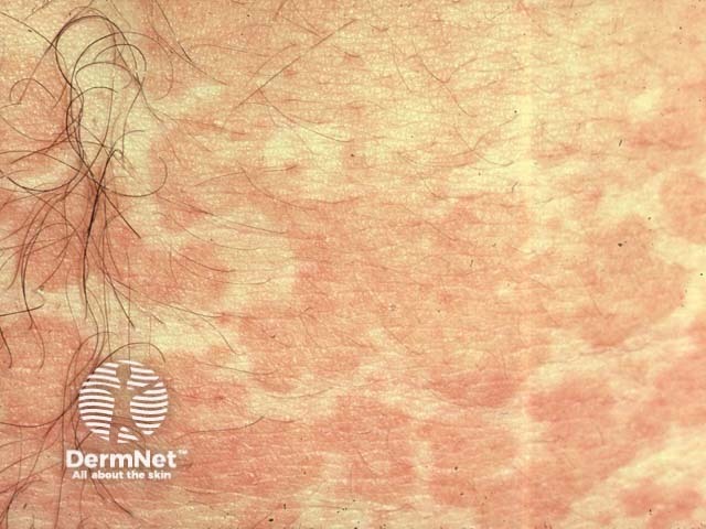 Manchas castanhas também são muito comuns na Tinea Versicolor.