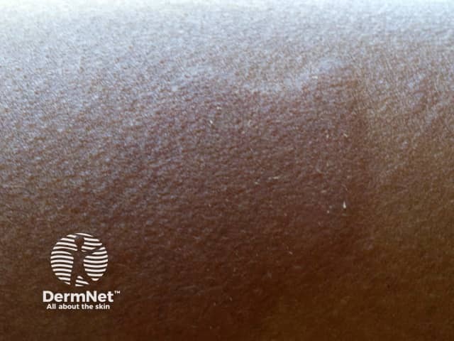 A urticária gera uma lesão elevada (pápula ou placa), facilmente palpável, que se projeta acima da superfície da pele circundante.