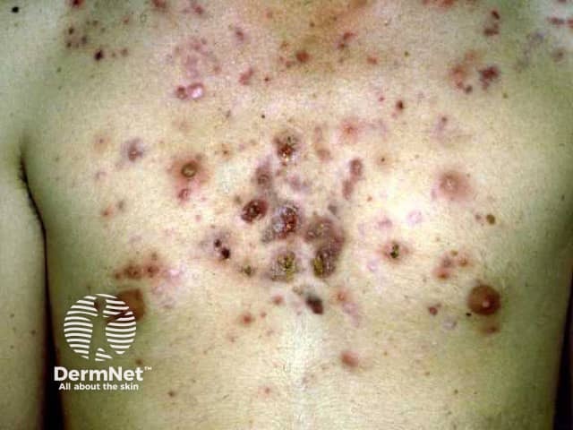 A acne nódulo-cística no tórax é uma inflamação grave que forma caroços profundos, dolorosos e endurecidos sob a pele. Por atingir camadas internas, ela apresenta um alto risco de deixar cicatrizes permanentes, tornando fundamental evitar qualquer tentativa de espremer as lesões. Como pomadas comuns não costumam ser eficazes nesse estágio, o tratamento exige acompanhamento médico para o uso de medicações orais específicas. Esse cuidado especializado é essencial para controlar a inflamação e preservar a integridade da pele na região do peito.