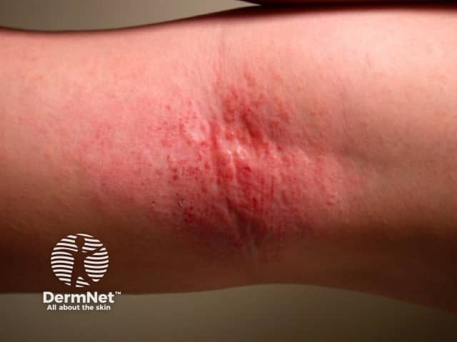 A dermatite atópica frequentemente atinge as flexuras cubitais (a dobra interna do braço), onde o acúmulo de suor e o atrito constante da pele facilitam a inflamação. Nessas regiões, é comum observar uma vermelhidão intensa, descamação e uma coceira persistente que pode até ferir o local. Por ser uma área de articulação, a pele tende a ficar mais grossa e sensível, exigindo hidratação reforçada para evitar crises.