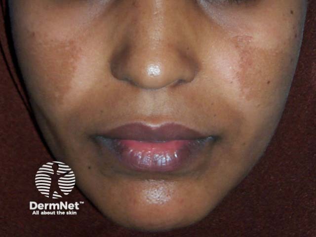 O melasma é significativamente mais prevalente em pessoas com fototipos altos (III a V), como peles pardas e negras, devido à maior atividade dos melanócitos. Nessas peles, a produção de melanina é mais intensa e reativa, respondendo bruscamente não apenas ao sol, mas também ao calor e à luz visível. O desafio do tratamento nesses casos é maior, exigindo cautela extrema para evitar inflamações que possam gerar hiperpigmentação pós-inflamatória.