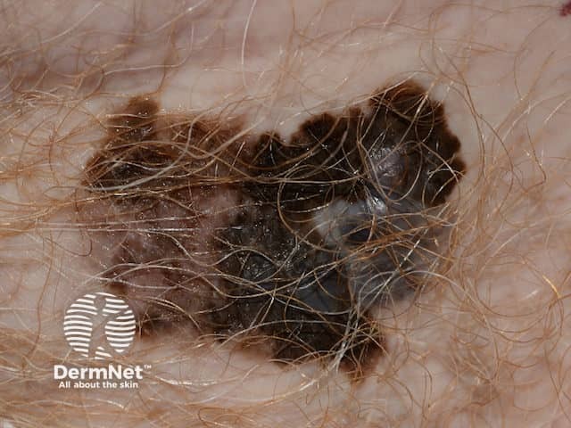 O melanoma extensivo superficial é a variante mais comum, manifestando-se como uma mancha de bordas irregulares e cores variadas, como tons de preto, marrom e cinza. Ele se caracteriza pelo crescimento horizontal na superfície da pele antes de invadir camadas mais profundas, facilitando a detecção precoce pela regra do ABCDE.

Devido ao seu comportamento evolutivo, o monitoramento de mudanças em pintas pré-existentes é crucial para evitar a progressão vertical e o risco de metástase.