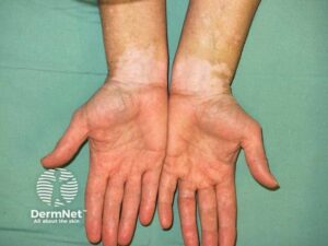 O vitiligo é uma doença autoimune da pele e das mucosas. Ele ocorre quando o sistema imunológico ataca por engano os melanócitos, que são as células responsáveis por produzir a melanina (o pigmento que dá cor à nossa pele). O resultado é o surgimento de manchas brancas ou mais claras, chamadas de máculas acrômicas ou hipocrômicas.