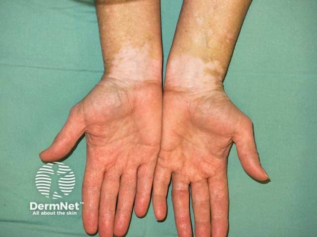 O vitiligo é uma doença autoimune da pele e das mucosas. Ele ocorre quando o sistema imunológico ataca por engano os melanócitos, que são as células responsáveis por produzir a melanina (o pigmento que dá cor à nossa pele). O resultado é o surgimento de manchas brancas ou mais claras, chamadas de máculas acrômicas ou hipocrômicas.