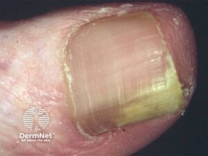 A onicomicose é uma infecção das unhas, principalmente nos pés, causada por fungos microscópicos. É uma das doenças de pele (dermatoses) mais frequentes no mundo, com uma prevalência que varia entre 7% e 10% da população geral.