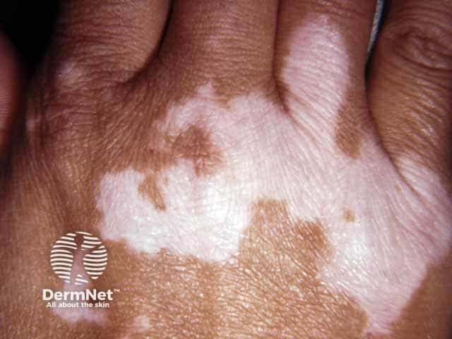 As mãos são um dos locais mais frequentes para o surgimento do Vitiligo, devido à alta exposição e ao constante atrito ou microtraumas. Por serem extremidades, o tratamento nessa região costuma ser um pouco mais lento do que no rosto ou tronco. O uso de proteção solar é indispensável para evitar queimaduras na pele clara.