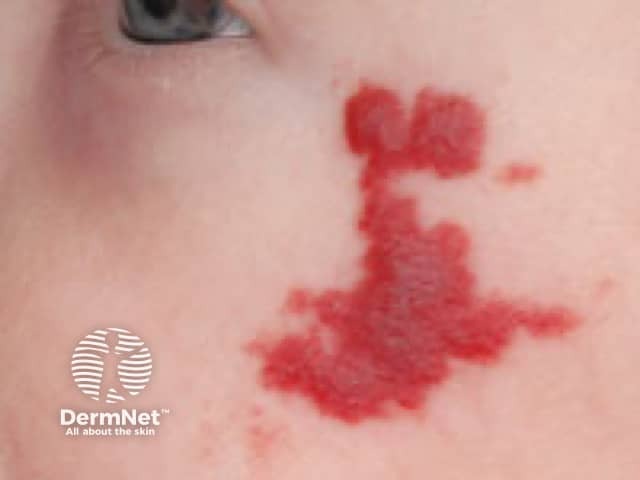 O hemangioma típico apresenta-se como uma placa ou nódulo vermelho-vivo, de superfície lobulada e firme, com bordas bem delimitadas sobre a pele sadia. Nas formas profundas, manifesta-se como um abaulamento azulado ou cor da pele, sendo caracteristicamente indolor e sem sinais inflamatórios de pus ou calor. Sua evolução é marcada por uma fase de crescimento acelerado nos primeiros meses, seguida por uma involução lenta que deixa a lesão opaca e murcha.