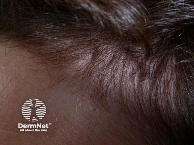 O sinal da franja frontal é um dos três sinais da tríade do Eflúvio Telógeno, indicando que a queda de cabelo já passou e os cabelos entraram na fase anágena.