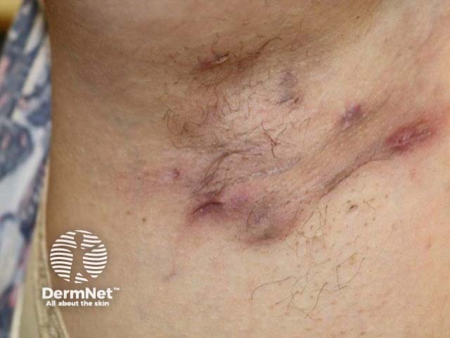 A hidradenite nas axilas causa nódulos inflamados e dolorosos que surgem devido à obstrução dos folículos, dificultando movimentos simples do braço.

Com a progressão, formam-se abscessos que rompem e drenam secreção, podendo criar túneis sob a pele e odores desagradáveis na região.

O processo recorrente resulta em cicatrizes fibróticas e endurecidas, que podem limitar a amplitude de movimento e escurecer a pele da axila.