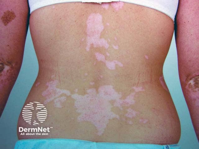 Durante a fototerapia para o Vitiligo, é comum e até desejável que a mancha apresente um leve eritema, que é aquela vermelhidão suave. Esse sinal indica que a luz estimulou a pele de forma eficiente, "acordando" as células que produzem cor. Se a pele ficar rosada a vermelha, o tratamento está no caminho certo. Não devemos esperar o surgimento de bolhas no local. 