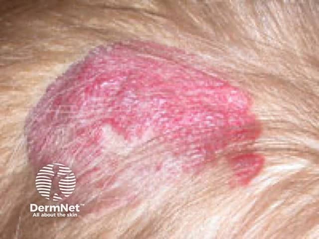 Sob o uso do propranolol, a regressão do hemangioma inicia-se com uma rápida mudança de cor, perdendo o vermelho brilhante para tons arroxeados ou pálidos devido à vasoconstrição imediata. A lesão torna-se notavelmente mais macia e menos tensa ao toque logo nos primeiros dias, interrompendo precocemente sua fase de crescimento. Com a continuidade do tratamento, ocorre o "murchamento" da superfície, que ganha um aspecto enrugado enquanto o volume regride de forma acelerada. Ao final, o medicamento induz a substituição do tecido vascular por tecido fibroso, minimizando sequelas e acelerando uma involução que levaria anos para ocorrer naturalmente.