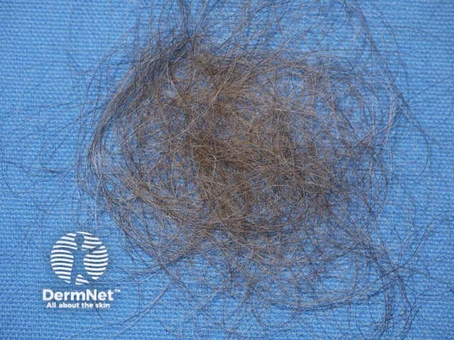 Se a queda de cabelo ultrapassa 100 fios de cabelo por dia o diagnóstico de Eflúvio Telógeno deve ser aventado.