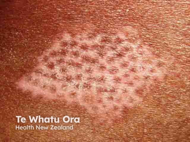 Quando o tratamento para o Vitiligo funciona, surgem pequenos pontos escuros no meio da mancha branca, chamados de ilhas de pigmentação. Elas geralmente aparecem ao redor dos poros e indicam que a cor está voltando de dentro para fora. Com o tempo, essas ilhas crescem e se unem para cobrir toda a área.