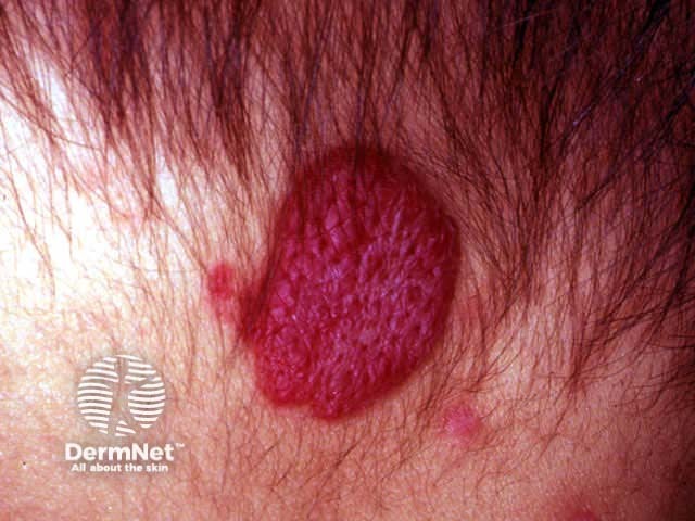 A denominação "hemangioma em morango" (do inglês strawberry hemangioma) é um dos termos mais clássicos da dermatologia para descrever a morfologia do hemangioma da infância superficial.