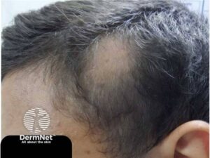 A alopecia areata é aquela que faz o cabelo cair de repente, deixando placas (semelhantes a clarões redondos no couro cabeludo, parecendo uma "moeda" sem fios). A pele nessas falhas fica lisinha, sem cicatriz nem nada, mas o susto é grande porque as placas peladas podem surgir do dia para a noite. É o próprio corpo "confundindo" as coisas e atacando a raiz do cabelo, comum quando o estresse está nas alturas.