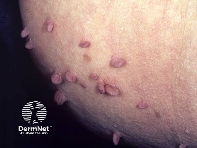 É frequente encontrar pessoas com dezenas de lesões de acrocórdon espalhadas pelo pescoço, axilas e virilhas ao mesmo tempo. Essa ocorrência múltipla muitas vezes está ligada à genética ou a alterações metabólicas, como a resistência à insulina e o diabetes. Embora sejam benignos e não contagiosos, o surgimento de muitos de uma vez é um sinal para conferir as taxas de açúcar no sangue.