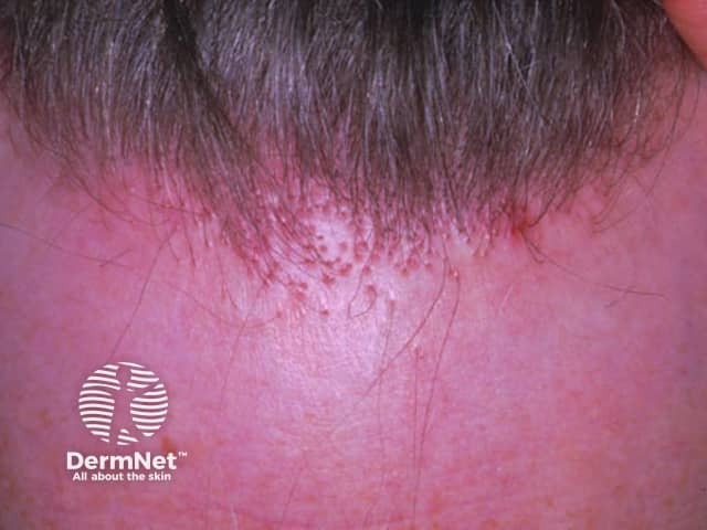 A inflamação ao redor da raiz dos fios, chamada de perifolicular, é o motor da alopécia fibrosante frontal. Ela se manifesta como uma vermelhidão ou descamação discreta na base do cabelo, sinalizando que o sistema de defesa está atacando o folículo. Se não for controlada a tempo, essa reação destrói a raiz e a substitui por uma cicatriz permanente. Por isso, identificar esse sinal visual cedo é crucial para interromper o recuo da linha do cabelo.