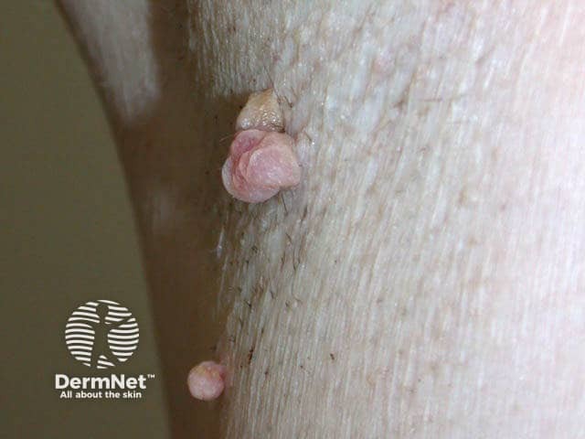 O acrocórdon é uma pequena lesão cutânea, geralmente da cor da pele ou levemente amarronzada, que se projeta como um "penduricalho". Frequentemente surge em áreas de dobra, como pescoço e axilas, sendo causado principalmente pelo atrito constante da pele ou roupas. Apesar de poder causar incômodo estético ou irritação, ele é um tumor benigno e não apresenta risco de se tornar cancerígeno. O tratamento é simples e rápido, realizado em consultório médico através de cauterização, crioterapia ou remoção cirúrgica com tesoura adequada.