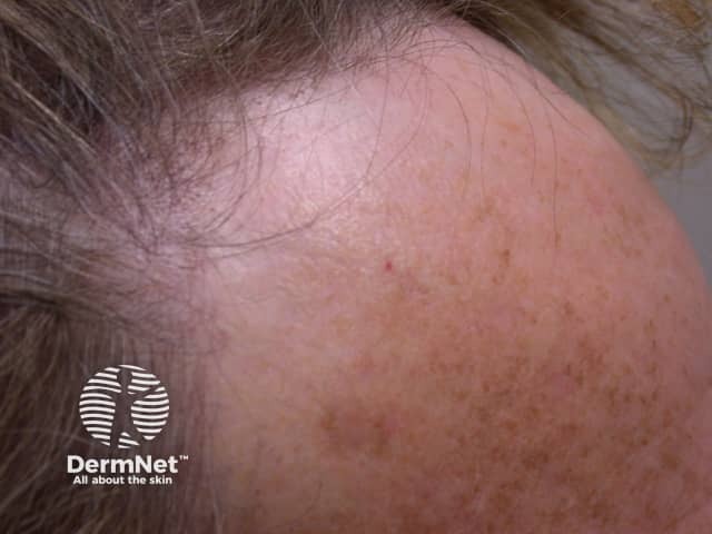 Na Alopécia Frontal Fibrosante (AFF), o recuo da testa revela uma pele com aparência "pálida" e lisa, pois os folículos foram substituídos por cicatrizes. Essa nova pele exposta costuma ser mais clara e uniforme do que a do resto do rosto, pois estava protegida pelo cabelo e não sofreu com o fotodano (envelhecimento causado pelo sol). O contraste é visível: abaixo da linha original há manchas e rugas solares, enquanto a área da perda recente parece "poupada" e intacta. É um sinal clássico que ajuda médicos a diferenciar essa calvície de outros tipos.