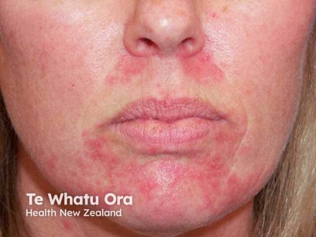 A dermatite perioral é uma inflamação comum da pele que se manifesta principalmente através de pequenas bolinhas vermelhas e descamação ao redor da boca. O problema é desencadeado ou agravado pelo uso inadvertido de pomadas com corticoides, entre outros fatores. Além do visual, o paciente costuma sentir uma sensação incômoda de ardência ou queimação, além de coceira.