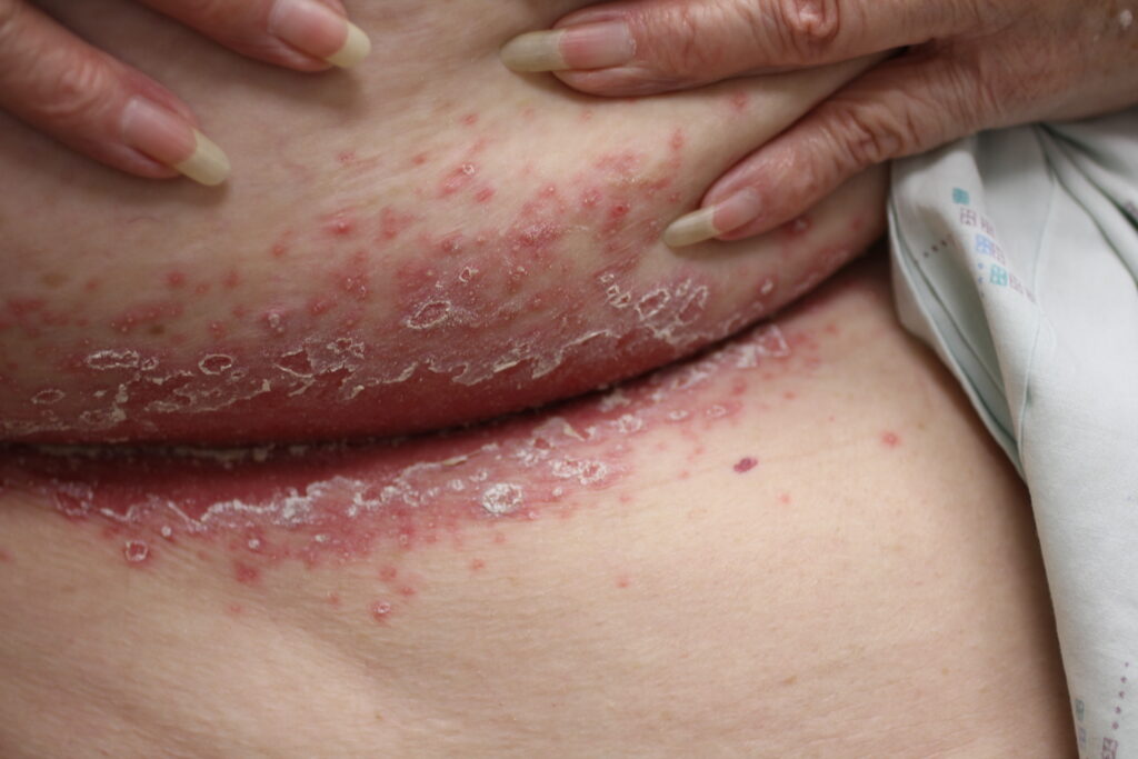 Quando o intertrigo é complicado por Candida, observam-se pápulas ("bolinhas") e pústulas ("bolinhas de pús") satélites e uma vermelhidão mais intensa e brilhante. Esta condição é comum em áreas como as axilas e a região inframamária, exigindo o uso de antifúngicos tópicos. A ardência e o prurido são sintomas marcantes que levam o paciente a buscar auxílio médico.