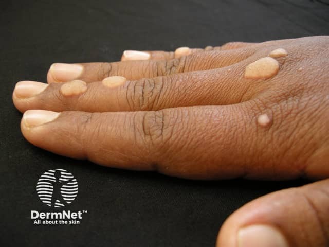 As verrugas nas mãos, conhecidas como verrugas vulgares, são causadas pelo vírus HPV e apresentam-se como elevações ásperas e endurecidas, muitas vezes com pequenos pontos pretos no centro. Elas são altamente contagiosas, espalhando-se facilmente através de microcortes na pele ou pelo hábito de roer as unhas. Embora benignas, exigem tratamento dermatológico para evitar que se espalhem para outras pessoas ou outras partes do próprio corpo.