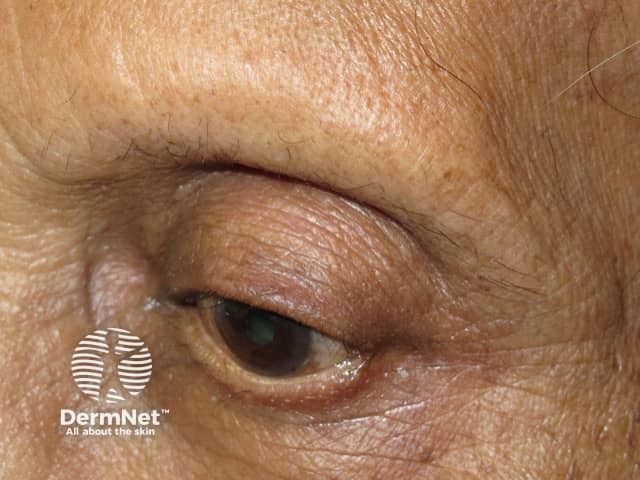 A madarose na Alopécia Frontal Fibrosante (AFF) é a perda total ou parcial dos pelos das sobrancelhas, sendo muitas vezes o primeiro sinal da doença.