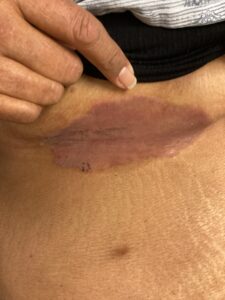 O intertrigo sob as mamas é frequentemente desencadeado pelo aprisionamento de suor e pelo atrito constante entre as superfícies cutâneas. Clinicamente, a área apresenta uma vermelhidão brilhante e úmida. A ventilação local e o uso de tecidos de algodão que impeçam o atrito das dobras são estratégias simples que auxiliam na redução da inflamação.