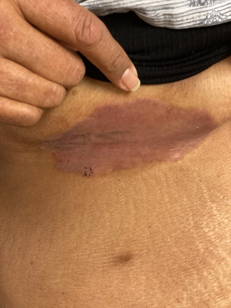 O intertrigo sob as mamas é frequentemente desencadeado pelo aprisionamento de suor e pelo atrito constante entre as superfícies cutâneas. Clinicamente, a área apresenta uma vermelhidão brilhante e úmida. A ventilação local e o uso de tecidos de algodão que impeçam o atrito das dobras são estratégias simples que auxiliam na redução da inflamação.