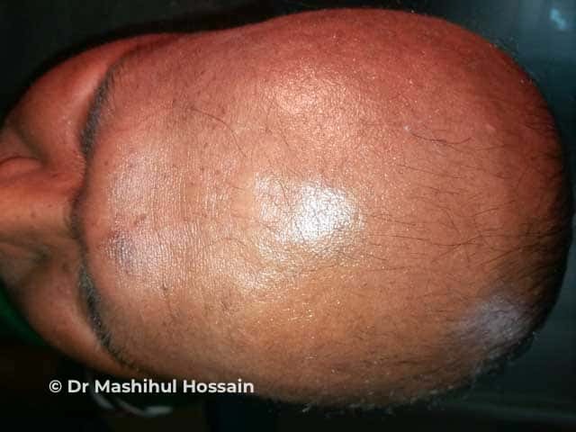 A alopecia areata total caracteriza-se pela perda completa e repentina de todos os fios de cabelo do couro cabeludo. Diferente da forma em placas, essa variante manifesta-se por uma interrupção generalizada do ciclo de crescimento capilar, deixando a região totalmente lisa. Embora o impacto estético seja severo, os folículos permanecem preservados sob a pele, em estado de dormência. O quadro é decorrente de uma resposta imunológica acentuada que ataca simultaneamente todas as unidades foliculares da cabeça.