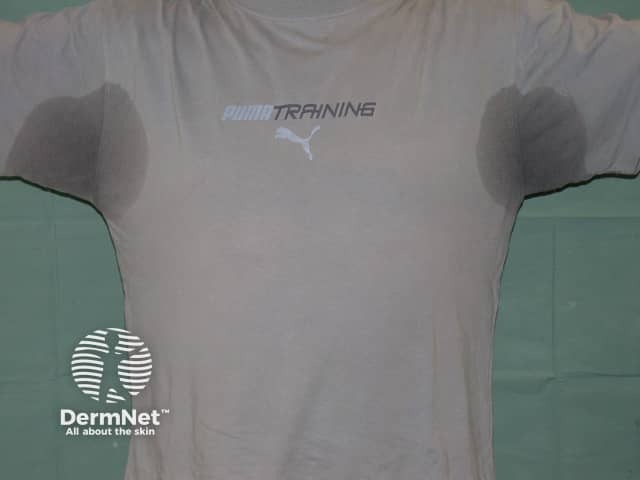 A hiperidrose é caracterizada por uma produção excessiva de suor, enquanto a bromidrose está relacionada ao mau cheiro corporal. Ambas as condições têm soluções e tratamentos que podem melhorar consideravelmente a vida das pessoas afetadas.