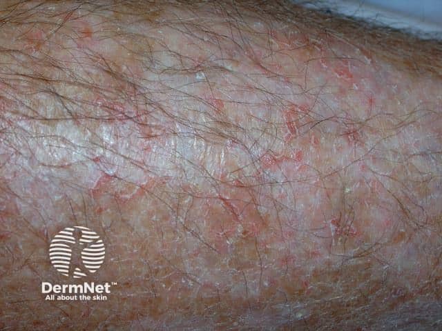 Um achado curioso da dermatite asteatósica é que o culpado, muitas vezes, é o hábito da higiene excessiva. A água muito quente e o uso de sabonetes agressivos removem o "manto lipídico", a nossa hidratação natural. Sem essa capa de gordura, a água interna do corpo evapora rapidamente, transformando uma pele saudável em uma superfície áspera, opaca e descamativa em poucos dias.