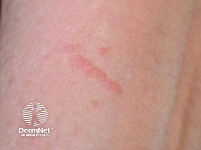 O fenômeno de Koebner ocorre quando novas verrugas surgem em áreas de pele saudável que sofreram traumas ou irritações, como cortes, arranhões ou o ato de barbear. Nesses locais, o vírus HPV aproveita a quebra da barreira cutânea para se instalar, criando lesões que muitas vezes seguem o formato linear do ferimento original. Por isso, evitar manipular ou coçar as verrugas é essencial para impedir que elas se "espalhem" seguindo esse padrão.