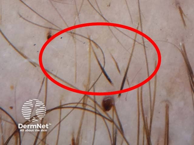 O dermatoscópio é como uma lupa potente que o médico usa para olhar o couro cabeludo bem de perto, sem precisar cortar nada. Com ele, dá para ver sinais típicos da alopécia areata, como fios que parecem "pontos de exclamação" ou pontinhos pretos onde o cabelo parou de crescer. Esse exame ajuda a confirmar se é alopecia mesmo ou só uma queda comum, permitindo um diagnóstico rápido e certeiro. É o jeito mais fácil de "enxergar" o que está acontecendo na raiz do problema antes de começar o tratamento.