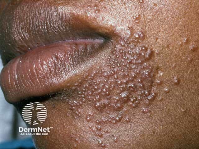O uso de pomadas com corticoides é o maior "vilão" da dermatite perioral: embora elas tragam um alívio falso e imediato, causam um efeito rebote devastador ao serem interrompidas. A inflamação volta muito mais grave, com bolinhas vermelhas intensas, pus e até inchaço na região. Esse ciclo de dependência vicia a pele e torna o tratamento muito mais longo e difícil. É o que chamamos de "dermatite induzida por corticoide", onde o remédio vira o próprio causador da doença.