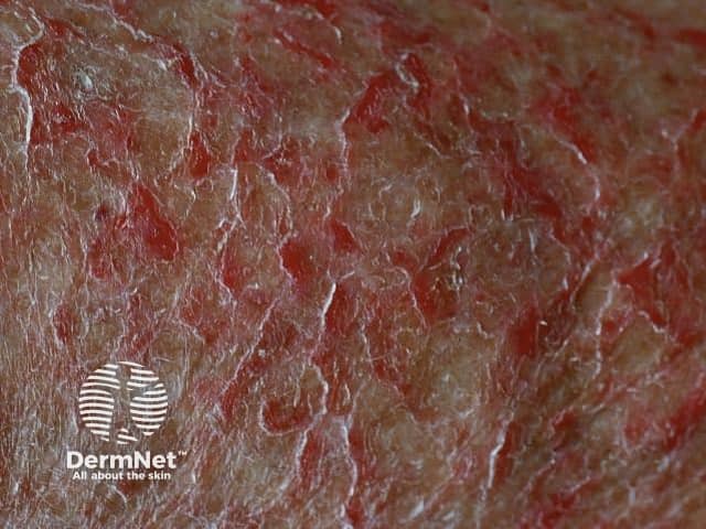 Quando a pele fica excessivamente seca, ela perde sua elasticidade e começa a "quebrar". O visual clássico da dermatite asteatósica lembra muito o fundo de um rio seco ou uma porcelana antiga craquelada. Essas fissuras ocorrem porque a barreira de gordura que protege o corpo desapareceu, deixando as camadas mais profundas expostas ao ambiente.