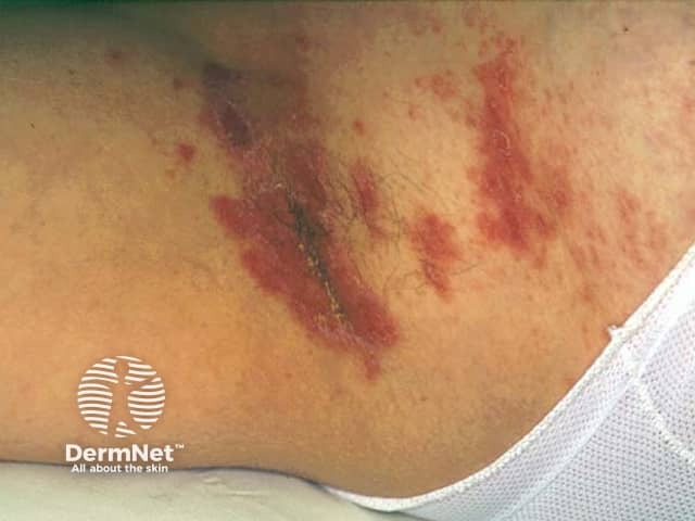 A região inframamária é um nicho ideal para o intertrigo candidiásico, caracterizado por uma vermelhidão profunda. Nestes casos, a maceração da pele pode evoluir para fissuras dolorosas e um odor típico da infecção por leveduras. O tratamento geralmente requer a associação de agentes secativos com cremes antifúngicos específicos.