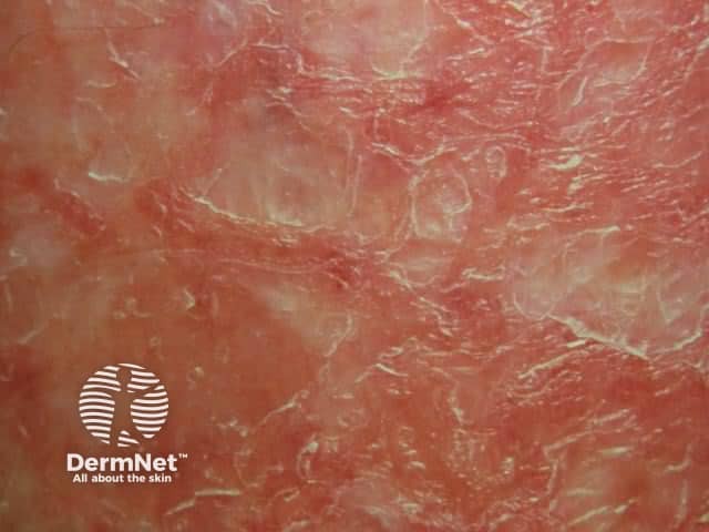 Um achado importante da dermatite asteatósica é que não basta apenas passar qualquer hidratante; a pele seca precisa de "reparo de barreira". Os melhores resultados vêm de produtos que contenham substâncias que imitam a gordura da pele, como as ceramidas. Aplicar o creme com a pele ainda levemente úmida após o banho ajuda a "selar" a água, devolvendo a integridade que a dermatite roubou.