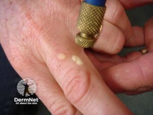 Após a aplicação do nitrogênio líquido através da Crioterapia, a verruga sofre um congelamento que forma uma bolha (as vezes com conteúdo hemorrágico) para separar a lesão da pele saudável. Nos dias seguintes, essa bolha seca e se transforma em uma crosta escura que cai naturalmente em até duas semanas, levando o tecido infectado junto. É fundamental não remover a crosta precocemente para garantir que a pele cicatrize sem manchas e que o vírus seja efetivamente eliminado.