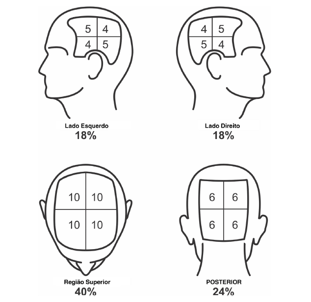 O escore SALT determina a extensão da perda capilar na alopecia areata por meio da soma dos percentuais de cada região do couro cabeludo, os quais aparecem subdivididos em quadrantes na imagem acima. Para o cálculo, o avaliador estima a área afetada em cada setor — considerando como alopecia a ausência de fios ou a presença de velos finos, e como repilação apenas o crescimento de fios terminais — de modo que a soma total define o índice final.