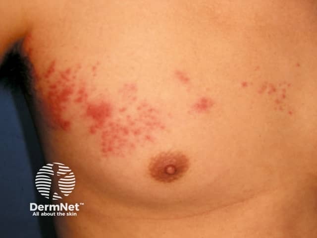 Uma característica bem típica do Herpes Zoster é que as lesões aparecem em forma de “faixa” na pele. Isso acontece porque o vírus atinge um nervo específico, fazendo com que as manchas e bolinhas surjam apenas de um lado do corpo, sem cruzar para o outro lado.