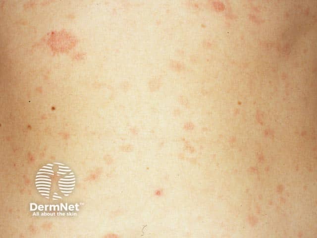 A Pitiríase Rósea geralmente começa com uma lesão maior, chamada de “placa mãe”. Depois de alguns dias, surgem várias manchas menores no tronco, seguindo linhas da pele, principalmente no peito e nas costas.