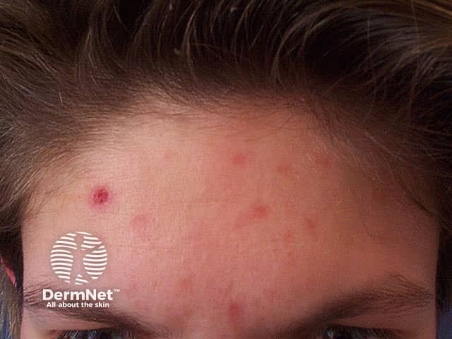 Na acne da mulher adulta, é comum a chamada acne escoriada, quando a pessoa manipula as lesões. Isso pode piorar a inflamação e dificultar a cicatrização da pele.